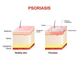 Funcționarea eficientă a Psorilax pe orice iritație