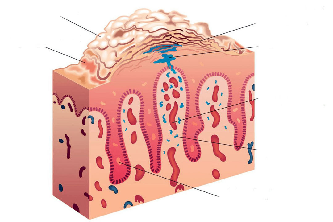 secțiunea transversală a pielii în psoriazis