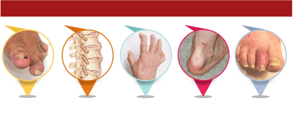 tipuri de artrită psoriazică