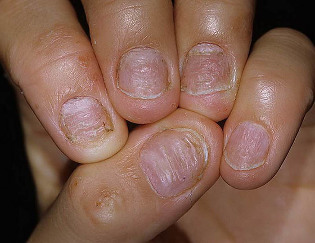 psoriazisul unghiilor